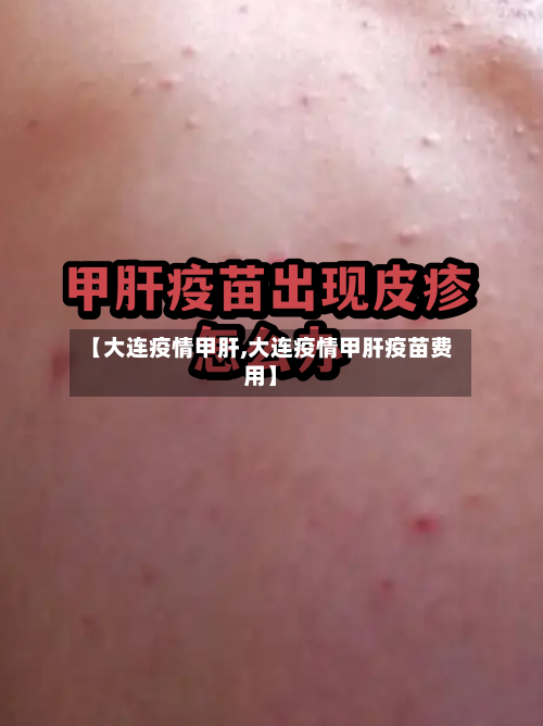 【大连疫情甲肝,大连疫情甲肝疫苗费用】-第3张图片